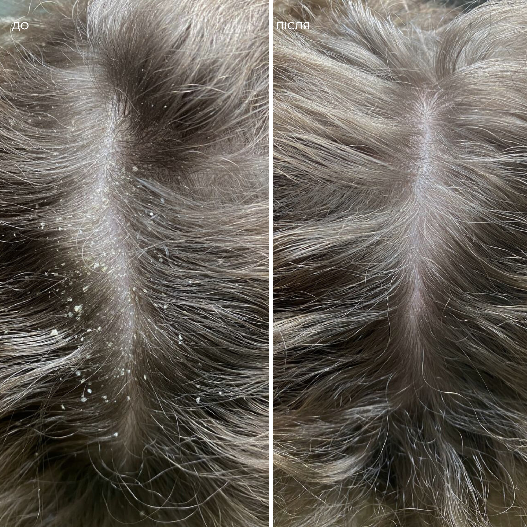 Пілінг проти лупи і себорейного дерматиту Flake Escape