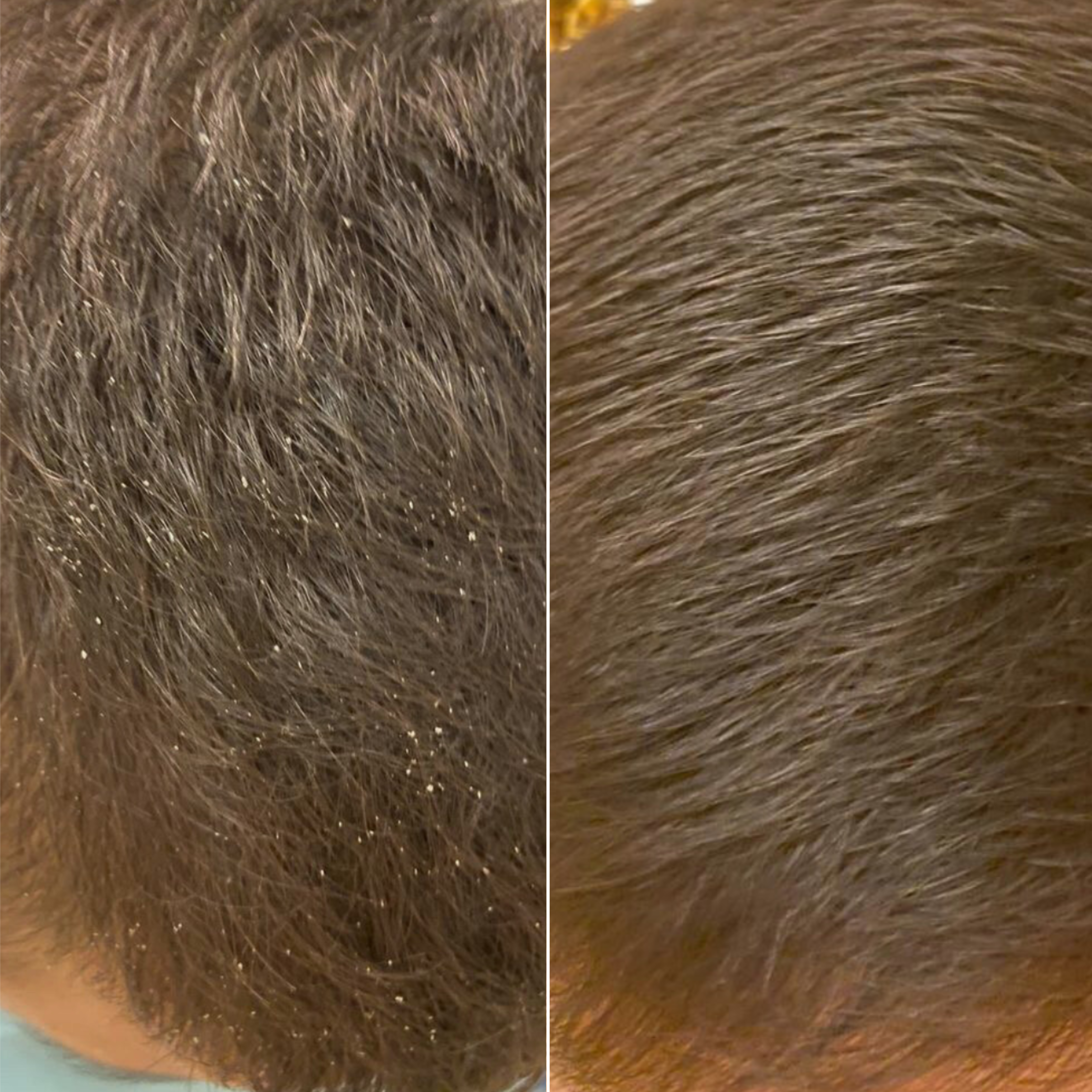 Пілінг проти лупи і себорейного дерматиту Flake Escape