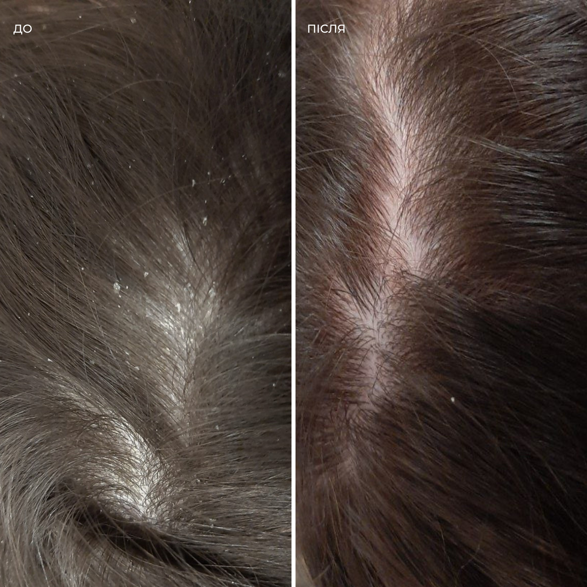 Набір проти лупи і себорейного дерматиту Flake Escape