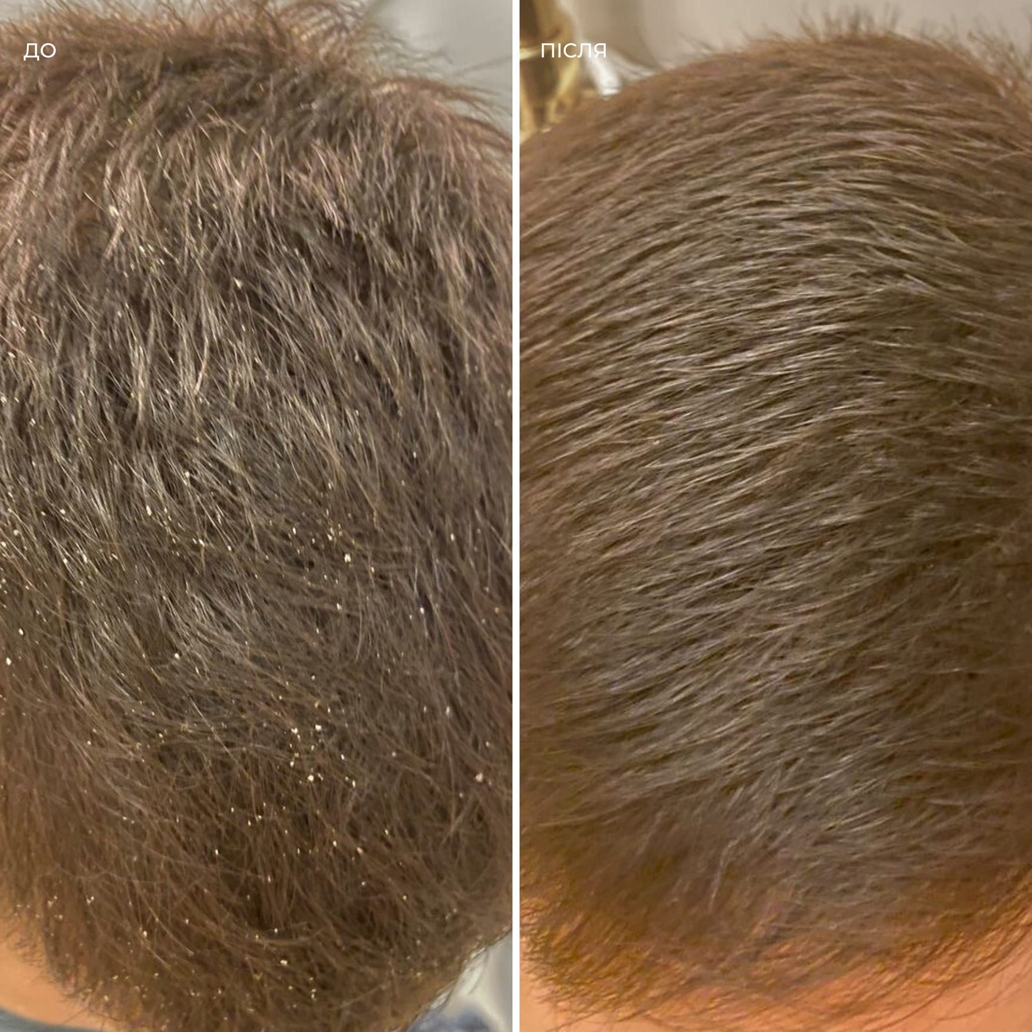 Набір проти лупи і себорейного дерматиту Flake Escape